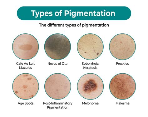 How To Get Rid Of Pigmentation - Aesthetic Clinic Malaysia