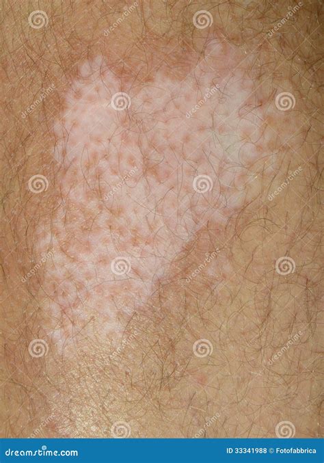 Vitiligo stock photo. Image of illness, health, spot - 33341988