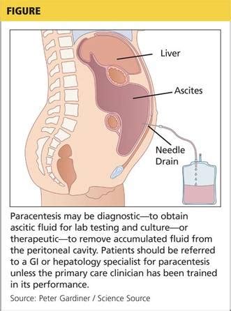 Cirrhosis Complications: Ascites and Spontaneous Bacterial Peritonitis ...