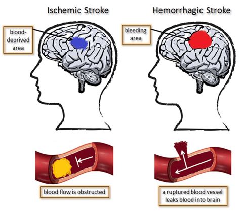 Ischemic Versus Hemorrhagic Stroke | My XXX Hot Girl