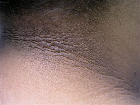 Acanthosis Nigricans: Causes, Symptoms and Treatment – Vitamin Resource