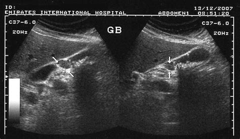 ON - RADIOLOGY: Adenomyomatosis of gall bladder-Segmental type