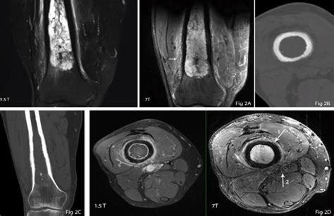 A: Coronal views of distal femur. Left side: T2 FS sequence using ...