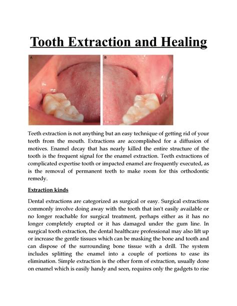 Tooth Extraction and Healing by VI Dental Center - Issuu