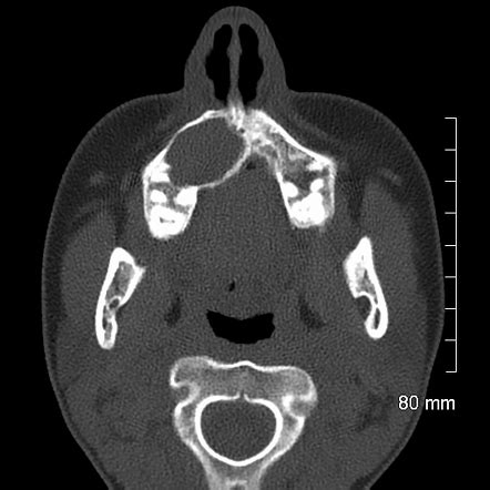 Central Giant Cell Granuloma Radiographic Features