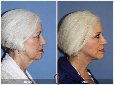 Neck Lift Before & After Photos Patient 02 | Dr Kevin Sadati