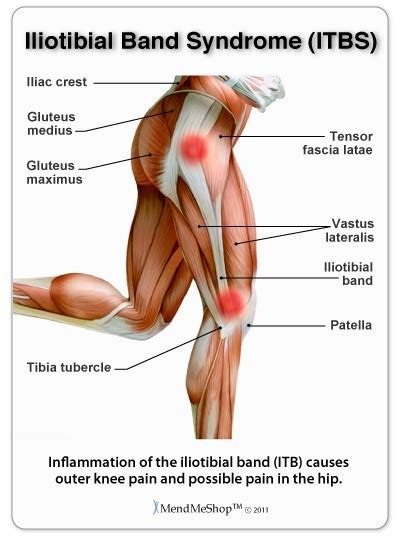 Iliotibial band syndrome - Arduua