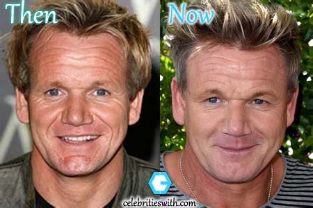 Gordon Ramsay Plastic Surgery, Before and After Botox Pictures ...