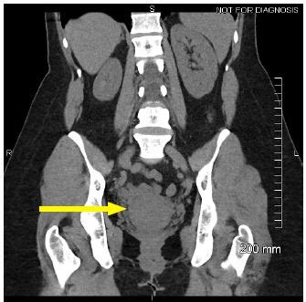 A Full Uterus: Hematometra from Cervical Scarring - The Western Journal ...