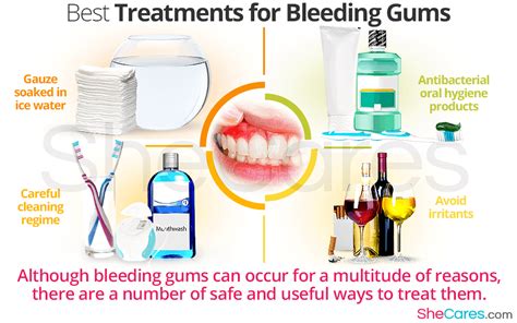 Best Treatments for Bleeding Gums | SheCares