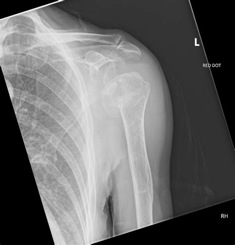 Large lipohaemarthorosis with pseudosubluxation | Image | Radiopaedia.org