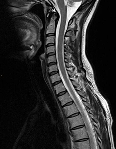 Mri Cervical Spine Neck Pain