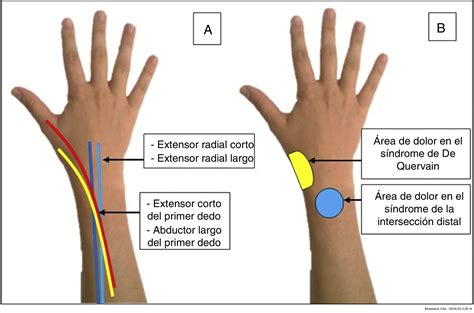 Tendinitis de Quervain - Fisioterapia en Forma