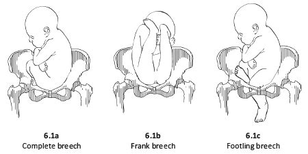 6.1 Breech presentation | MSF Medical Guidelines