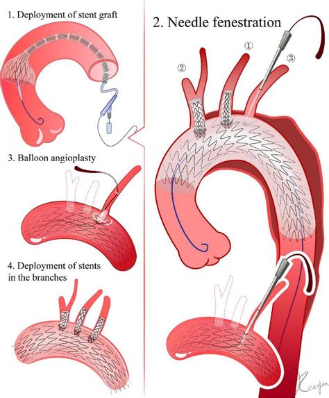 Needle fenestration. 1. Delivery of the stent graft. The ascending ...