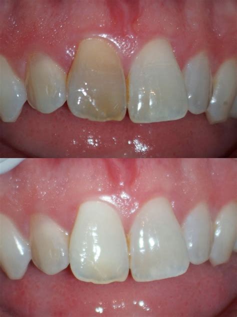 The Endo Blog: Internal Bleaching of VITAL Teeth | Dental practice, Dental, Blink of an eye