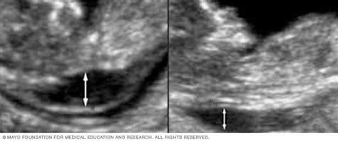 Nuchal translucency measurement - Mayo Clinic