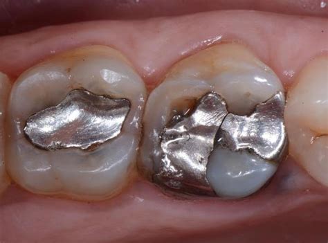 Dental restoration: When and Why are they redone? | Dentistry33