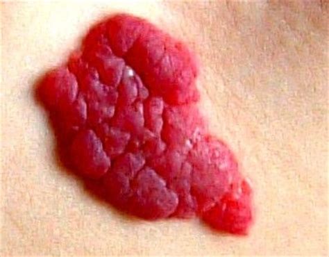 Red Birthmarks Causes, on Face, Head, Neck, Arm, Baby & Red Raised Birthmarks | BeautyZion ...