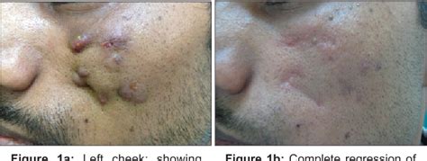 Figure 1 from Unusual presentation of scrofuloderma in an ...