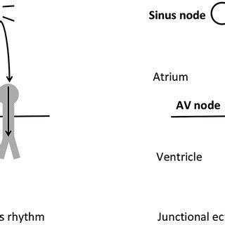 (PDF) Junctional ectopic tachycardia in infants and children