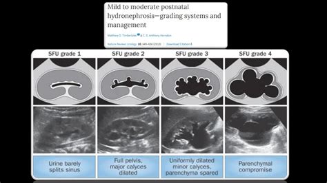 Hydronephrosis Grading Ultrasound