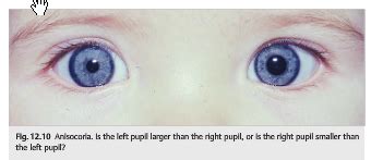 Neuro-ophthalmology Questions of the Week: Pupils – Anisocoria — Neuro ...