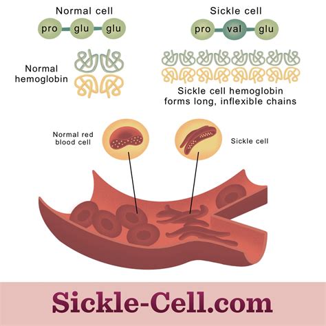 Sickle Cell Anemia Mutation