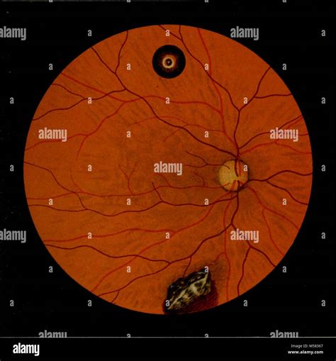 "Atlas and epitome of ophthalmoscopy and ophthalmoscopic diagnosis ...