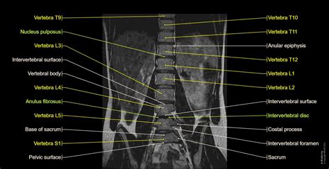 Anatomy of the lumbar vertebrae: normal anatomy | e-Anatomy