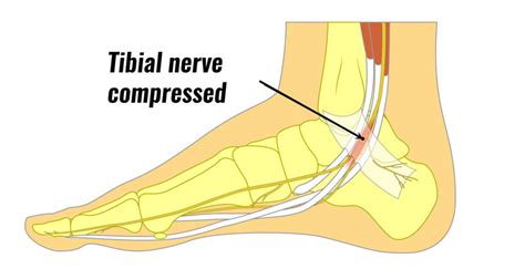 Best Treatment for Foot Pain: Tarsal Tunnel Sheboygan Wi