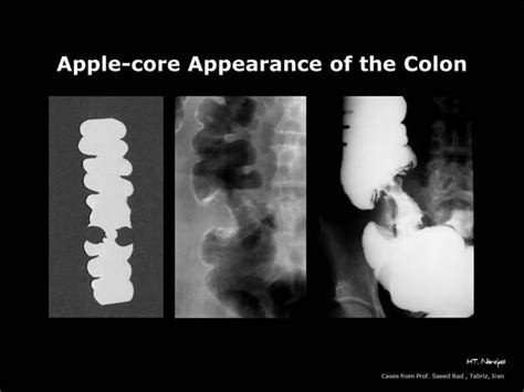 The apple core sign, also known as a napkin ring sign (bowel), is most ...