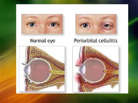 DISORDERS OF THE LACRIMAL SYSTEM The lacrimal