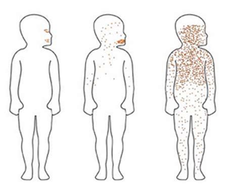 Symptoms of Infection - The Measles Virus