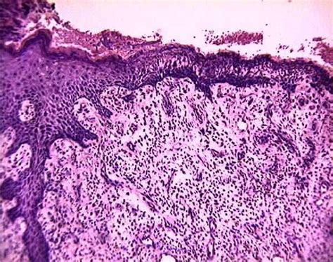 Granulation Tissue Histology