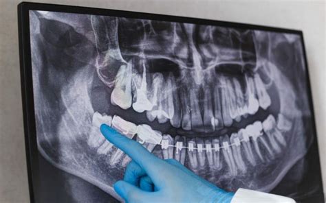 complications of impacted wisdom teeth - Bradford Family Dentistry