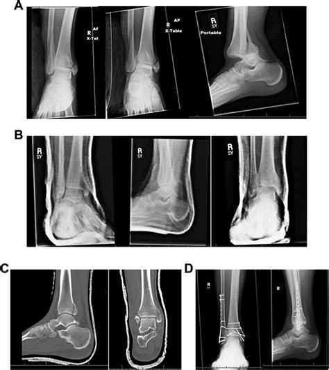 Displaced Trimalleolar Ankle Fracture