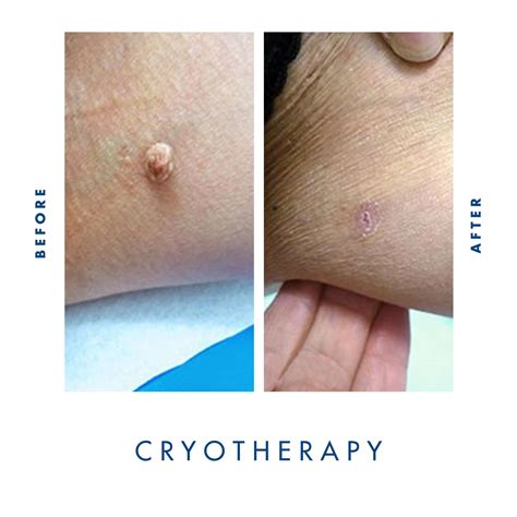 Cryotherapy Deep Dive - Skin Tags - Cryosthetics