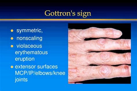 Symptoms of Dermatomyositis - PT Master Guide