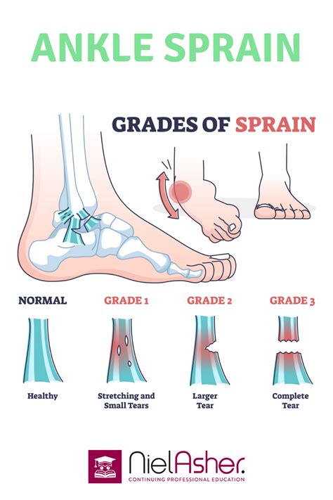 The Different Types of Ankle Sprain | Sprained ankle, Sprain, Ankle ...