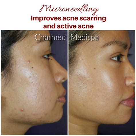 Improvement Of Acne Scarring And Active Acne With Microneedling SkinPen – Charmed Medispa