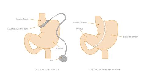 Gastric Sleeve vs. Lap Band: Making the Right Choice