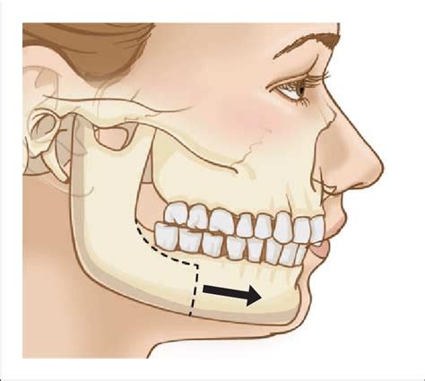 Schematic Illustration Of Mandibular Ramus Sagittal Split Osteotomy | Images and Photos finder