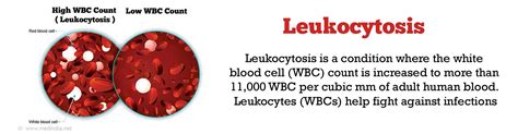 Leukocytosis - Causes Symptoms Diagnosis Treatment