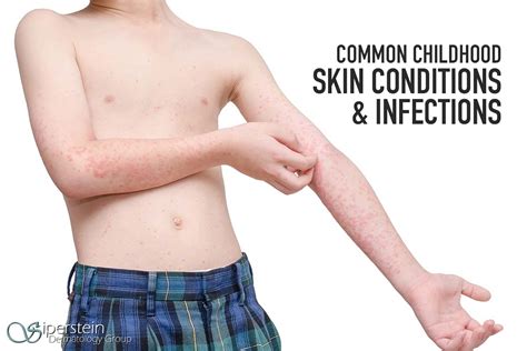 A Handy Guide To Common Childhood Viral Skin Conditions