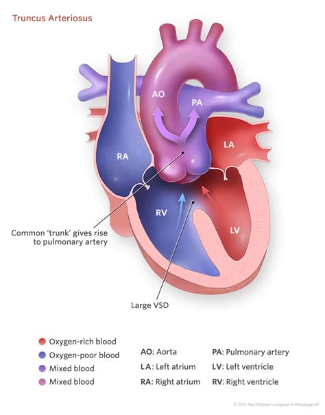 Truncus Arteriosus | Children's Hospital of Philadelphia