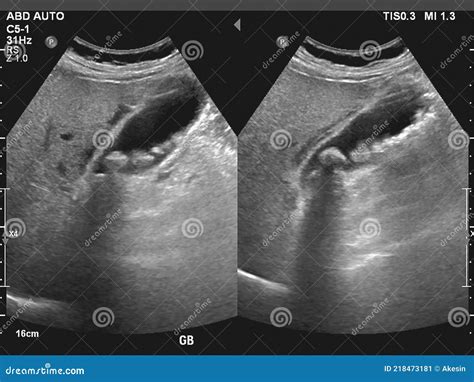 The Cut Stones In The Gallbladder Lie On The Gauze. Laparoscopy ...