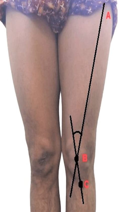 Cureus | Quadriceps Angle Measurement in Adolescents With Short Stature ...