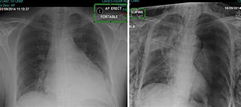 A Guide to Mobile Chest X-rays for Thoracic and Cardiac Care ...