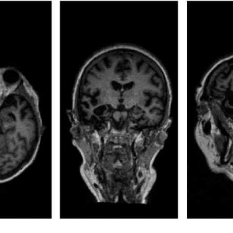 (PDF) A MEG study of the neural substrates of semantic processing in semantic variant primary ...